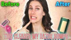 Razor Bumps? Same. Here are ways to deal with underarm pimples and razor burn!